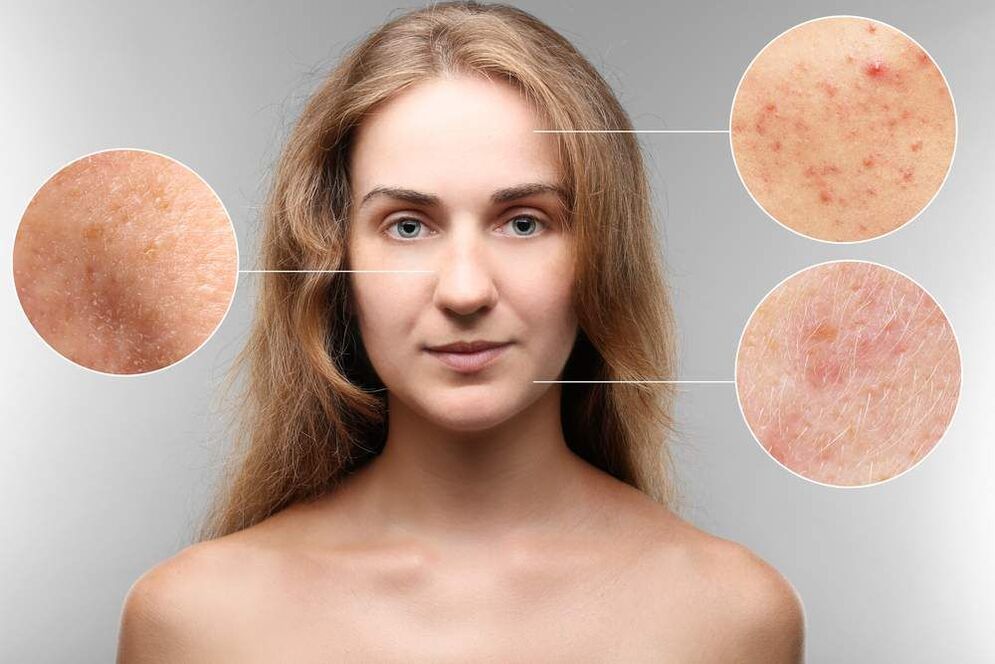 rashes dina beungeut alatan parasit